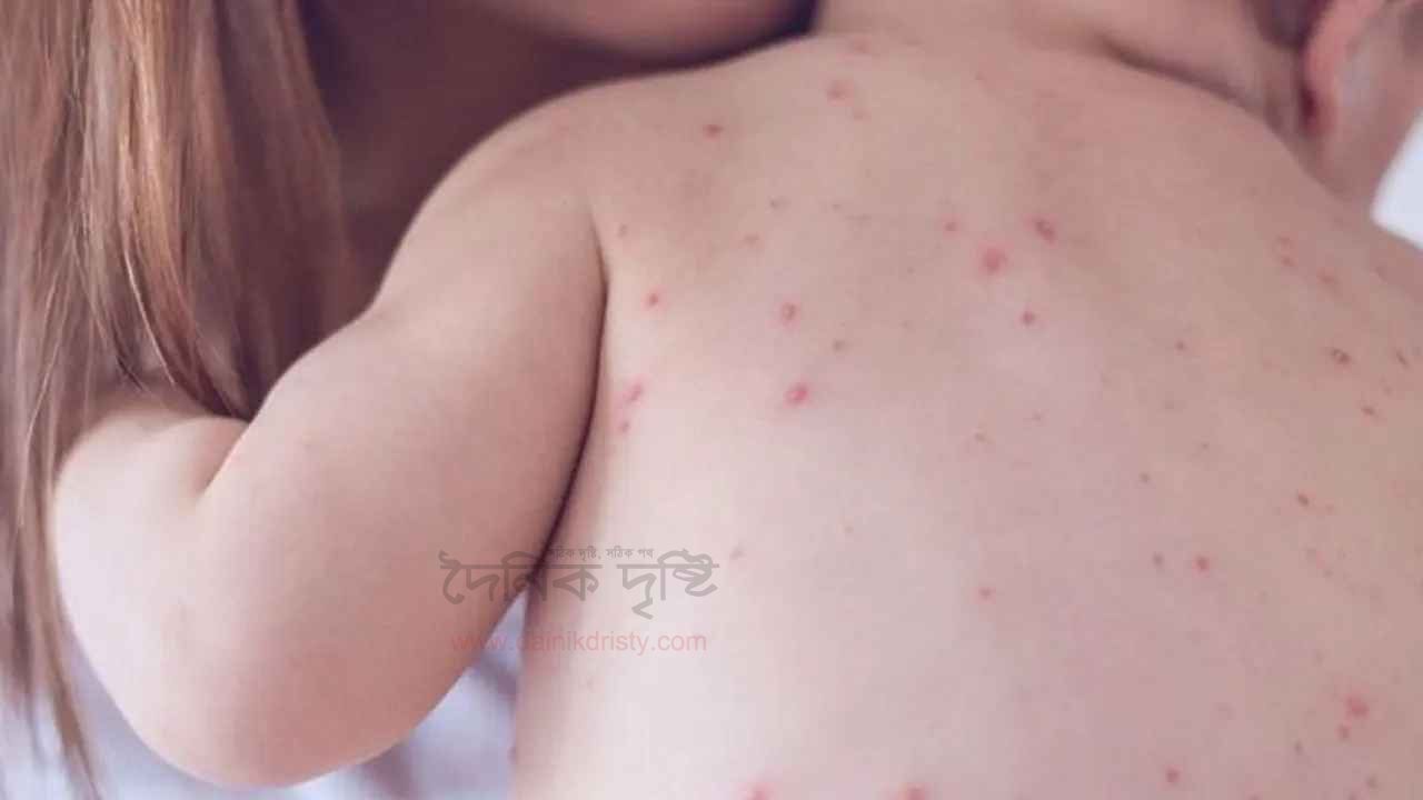 হামে দেশে আরও ৭ শিশুর মৃত্যু