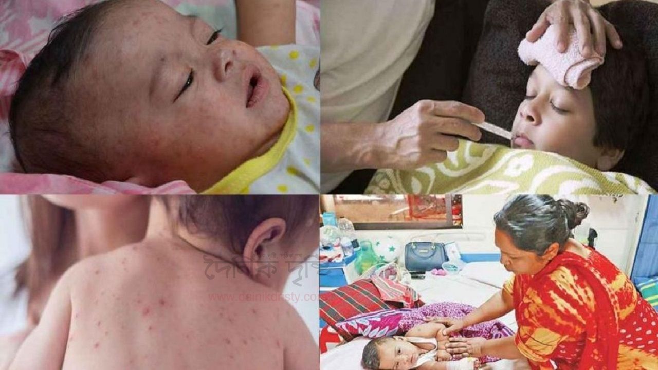 হাম নিয়ন্ত্রণে ব্যর্থ সরকার, শিশুমৃত্যুতে বাড়ছে শঙ্কা